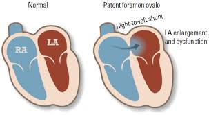schematic patient foramen ovale